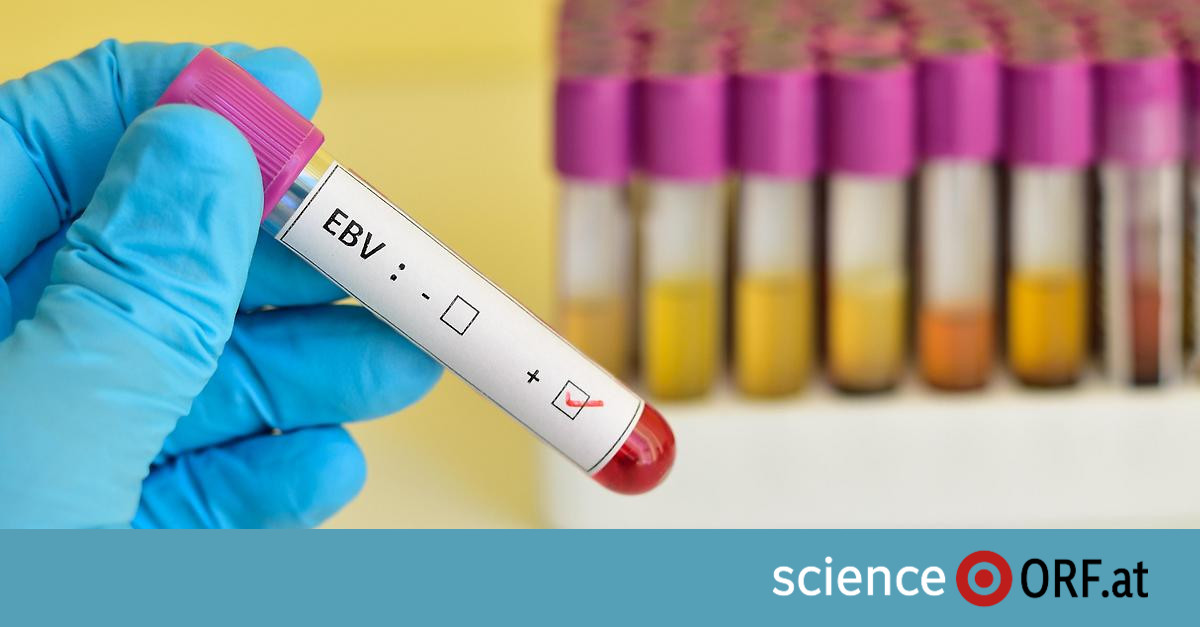 Virus di Epstein-Barr: progressi nella ricerca di un vaccino