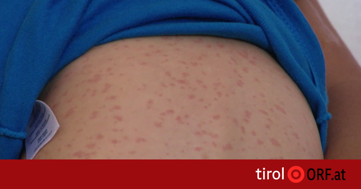 The third case of measles in the Kufstein region